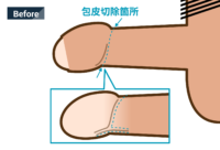 プライベートクリニック式包茎治療（プラクリ式）：施術前