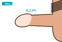 プライベートクリニック式包茎治療（プラクリ式）：施術後