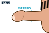 一般的な包茎治療：Before