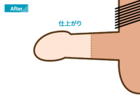 一般的な包茎治療：After