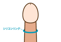 シリコンリング挿入イメージ