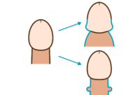 陰茎増大術のイメージ