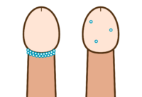 尖形コンジローム