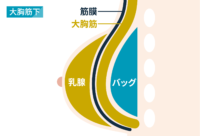 豊胸：大胸筋下タイプ