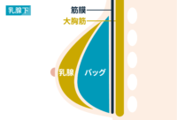 豊胸：乳腺下タイプ