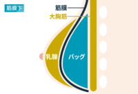 豊胸：筋膜下タイプ