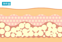 脂肪吸引：施術前