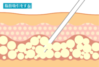脂肪吸引：吸引をする