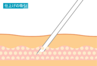 脂肪吸引：仕上げの吸引