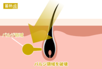 蓄熱式レーザー